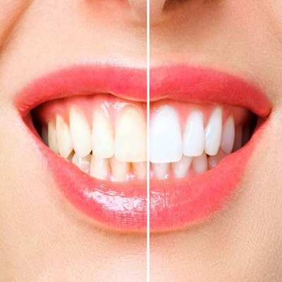 NAILS 365 SPA & MASSAGE - Teeth whitening